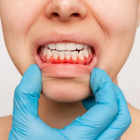 Gum Treatment 